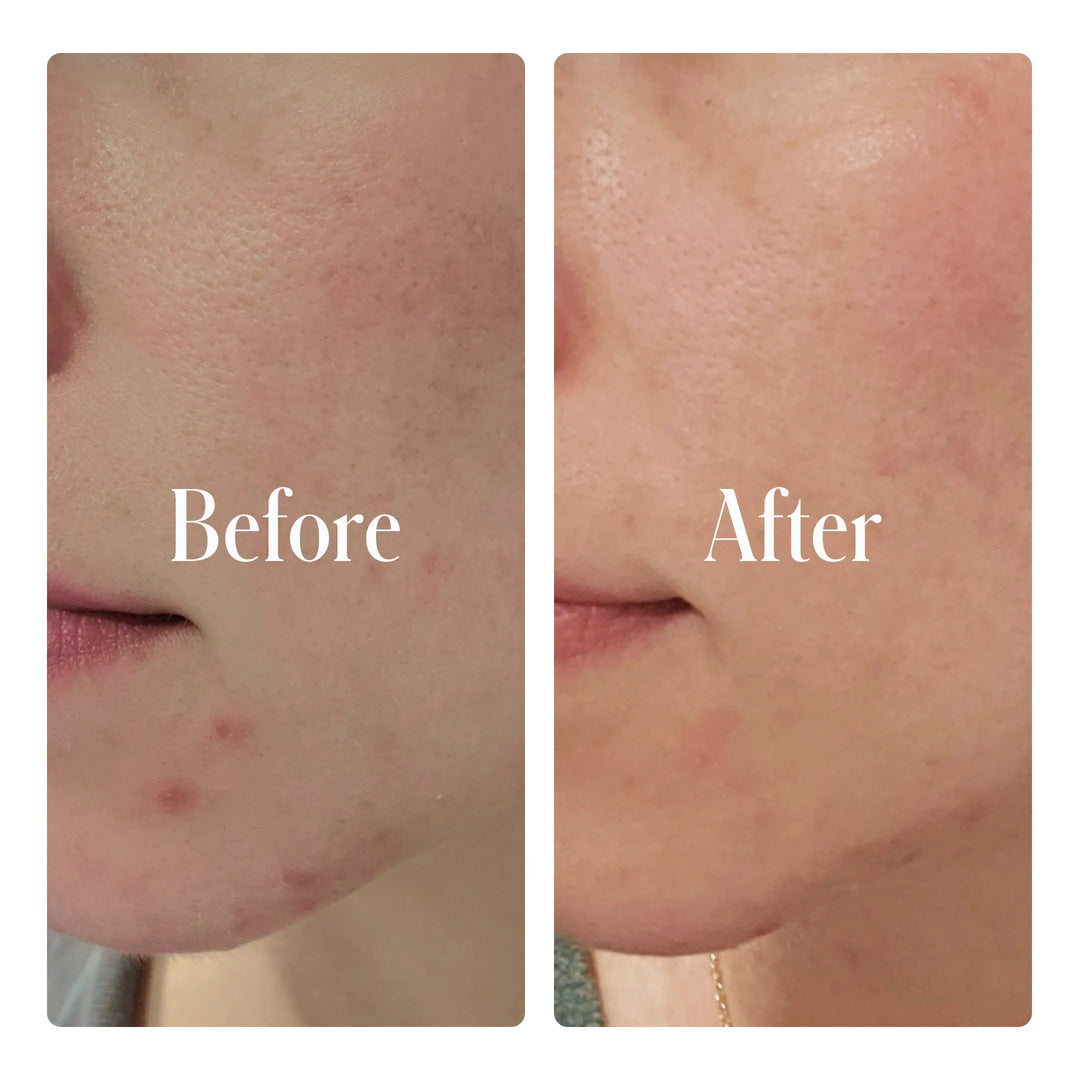 Acne Control Face Care 3 Step Set